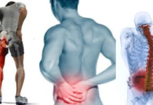 Sciatica: come sconfiggere il dolore