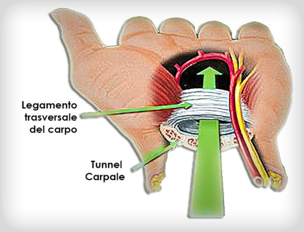 tagmedicina, sindrome del tunnel carpale