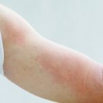 Quali sono i farmaci che inducono orticaria tagmedicina,orticaria