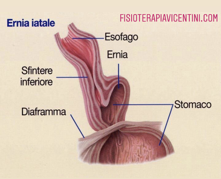 Ernia Iatale E Reflusso Gastro Esofageo medicina Giornale Medico On Line Salute Benessere Prevenzione E Aggiornamenti Del Settore Medico