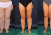 Lipedema: accumulo di grasso a livello delle gambe, dolore e formicolii #tagmedicina,lipedema