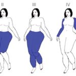 lipedema 1
