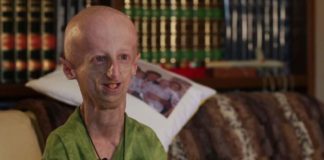 tagmedicina,progeria
