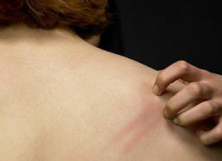 Malattie Rare: Sindrome di Morgellons #tagmedicina,sindrome