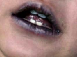 Malattie Rare:Metaemoglobinemia #tagmedicina,metaemoglobinemia