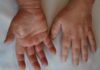 Malattie Rare: Acromegalia, sintomi e trattamento tagmedicina,Acromegalia