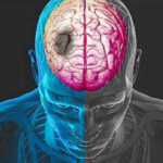 Ictus: sintomi e fattori di rischio tagmedicina,Ictus