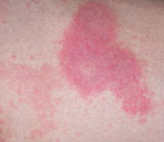 Covid-19 e dermatosi, il paziente zero risale a novembre 2019. Ecco lo studio italiano tagmedicina,Covid