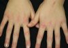 MALATTIE RARE: DERMATOMIOSITE tagmedicina,DERMATOMIOSITE