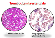 MALATTIE RARE: Trombocitemia essenziale