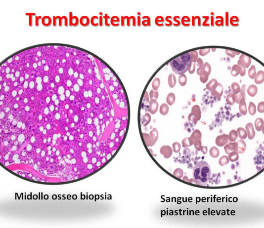 MALATTIE RARE: Trombocitemia essenziale