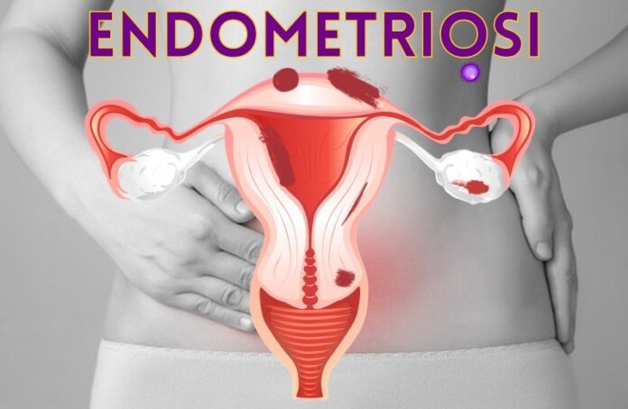 tagmedicina, endometriosi