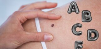 ABCDE: l’alfabeto del melanoma