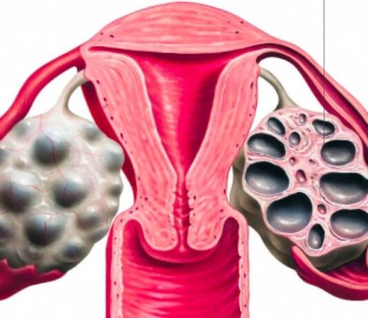 La sindrome dell’ovaio micropolicistico nelle giovani donne, facciamo il punto